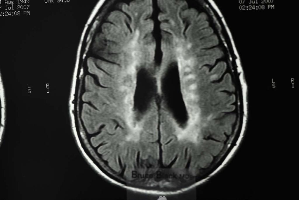 MS. Typical periventricular enhancement on CT.