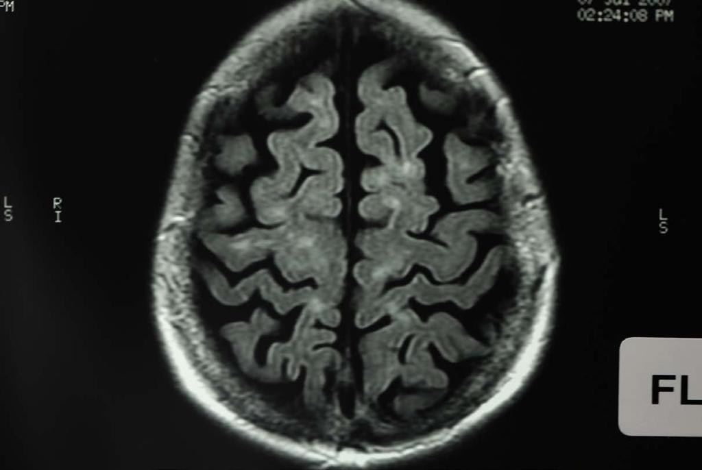 Gross cerebral atrophy, age related.
