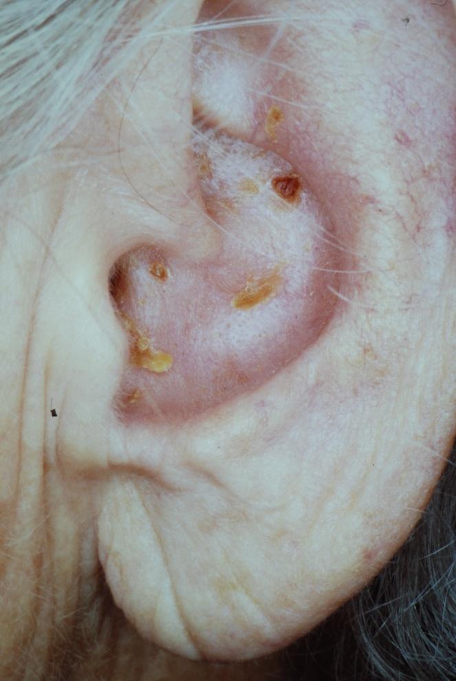 Healing auricular herpes zoster vesicles.