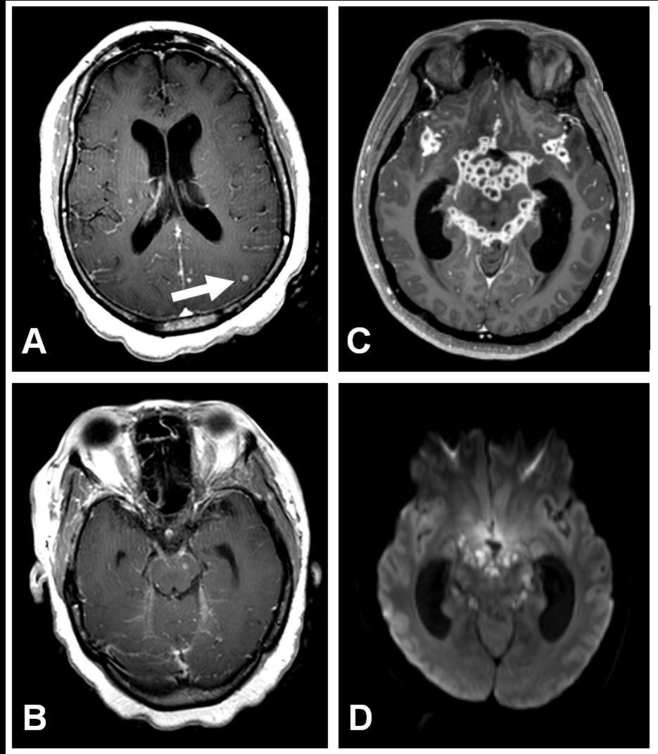 Leptomeningitis in tuberculosis Axial graphic shows the early capsule Klein formation of JP, an abscess in Youmans with central liquified and