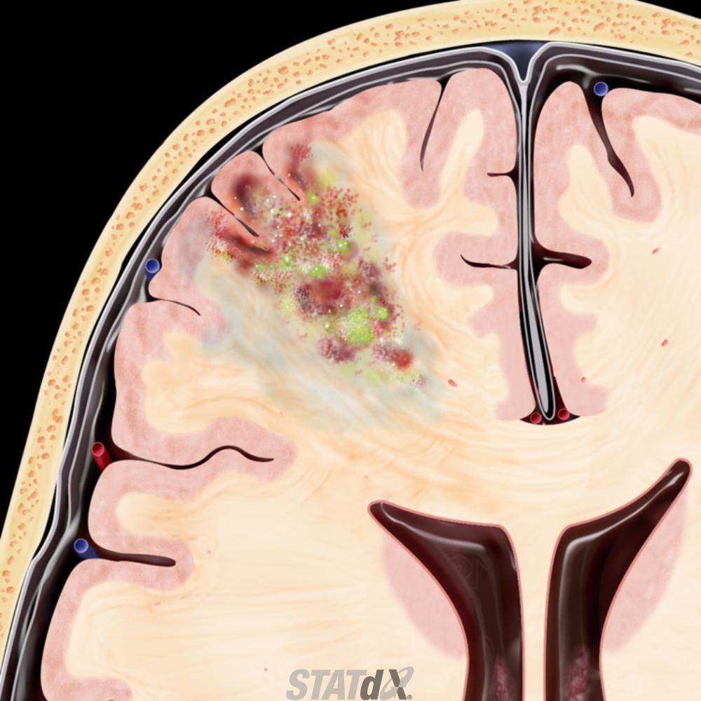Cerebritis Abscess Axial graphic shows early