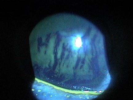 tear film instability secondary to loss of epithelial microvilli The corneal epithelial changes required to cause tear film instability occur late in the natural history of dry eye syndrome 7 8 9 WHY