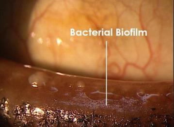 the meibum Obstructive process is influenced by the following factors Age Sex Hormonal disturbances Topical medications Biofilm Theory In dry eye blepharitis syndrome (DEBS), eyelid margin disease