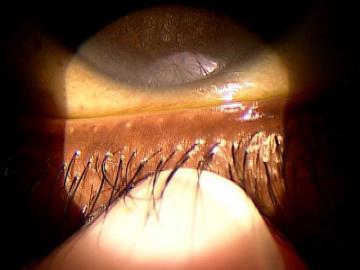 slower and the biofilm accumulation effectively results in a pipe-stemming of the eyelash FOLLICULITIS MEIBOMIAN GLAND DYSFUNCTION A layer of biofilm within the gland Inflammatory damage has begun