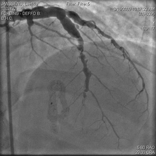 LAD A 48 occlusion h coronary and arteriography: