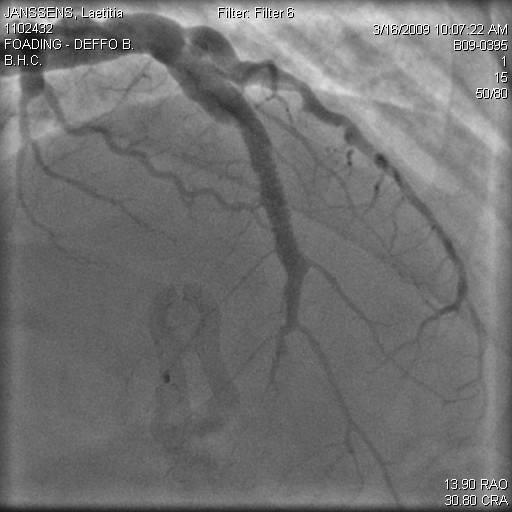 A 48 h coronary arteriography: