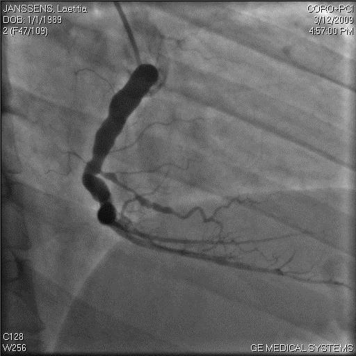 Stenosis at mid and distal right coronary