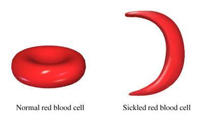 B. Co-dominant Inheritance $ Sickle Cell Anemia - affects the hemoglobin in red blood cells - leads to clots, reduced blood flow and constant pain.