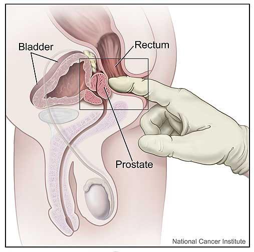 While normal growth of the prostate affects most men, approximately 1 out of 10 men will develop cancer of the prostate.