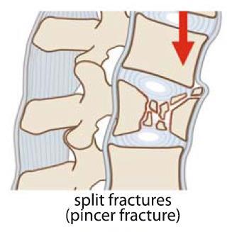 used to treat minimally displaced Type A1, A2 fractures and some Type