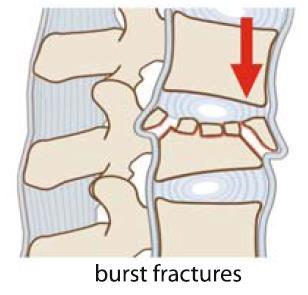 3 fractures, use of the load sharing classification (LSC) to determine