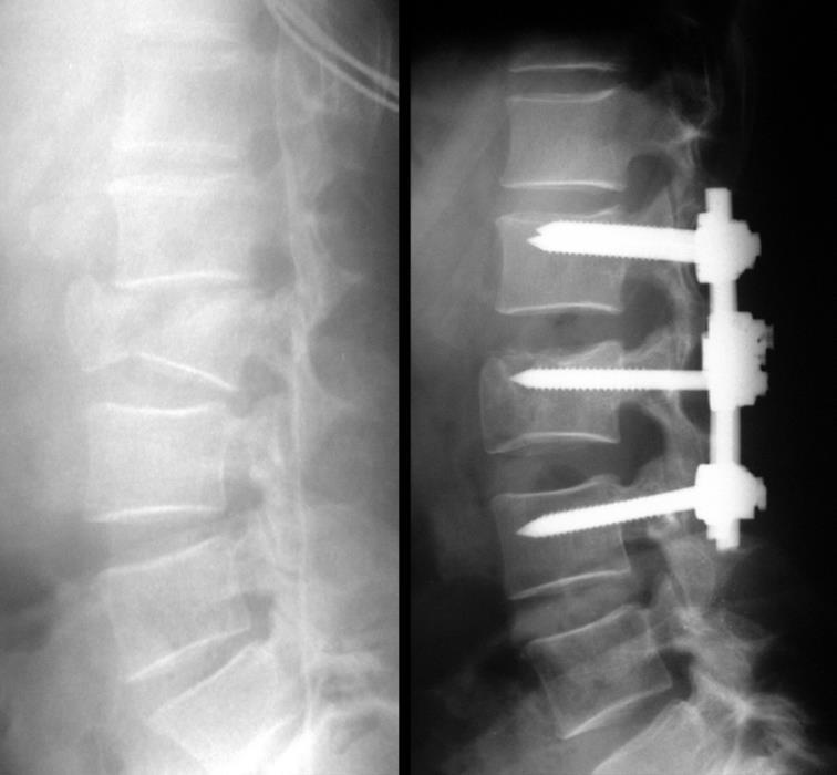Percutaneous Transpedicular Fixation Use of screw at the fracture level in the treatment of thoracolumbar fractures.