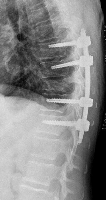 Percutaneous Transpedicular Fixation Short versus long constructs. Indications of long segment fixations: Fracture-dislocations (injuries with translation), PCL injury.