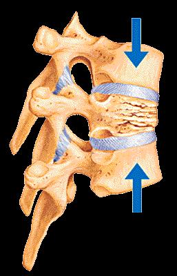Introduction. The application of MIS techniques to TL trauma has to adhere to the basic principles of surgical spinal trauma management (i.e., decompression, reduction/realignment, anterior column support, restoration of the posterior tension band when necessary, and fusion).