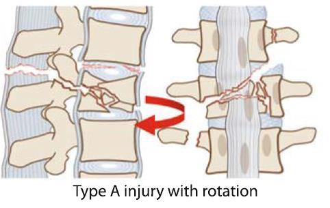 Anterior Structural Support. Indications.