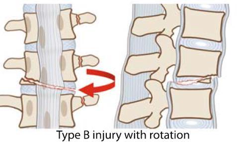 open) Type B1 fractures and even Type C fractures, if the posterior