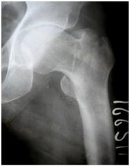 12. Zeng C, Wang Y-R, Wei J, Gao S-G, Zhang F-J, Sun Z-Q, Lei G-H: Treatment of Trochanteric Fractures with Proximal Femoral Nail Antirotation or Dynamic Hip Screw Systems: a Metaanalysis.