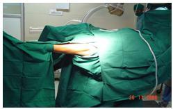 Shen L, Zhang Y, Shen Y, Cui Z: Antirotation proximal femoral nail versus dynamic hip screw for intertrochanteric fractures: A meta-analysis of randomized controlled studies.
