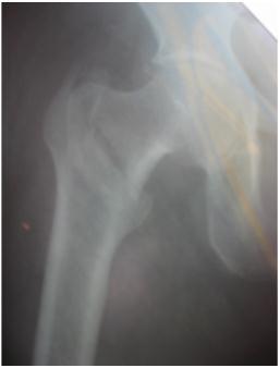 6: Pre-operative radiography of 55 yrs