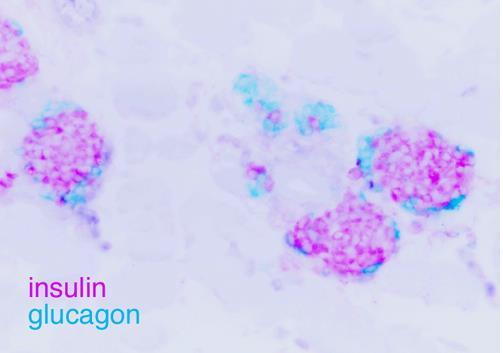 destruction of insulin producing ß-cells