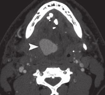 Diagnostic Performance of CT ngiography for External Carotid rtery Injuries and Their Treatment The sensitivities for EC injuries ranged from 63.4% (95% CI, 45.5 79.