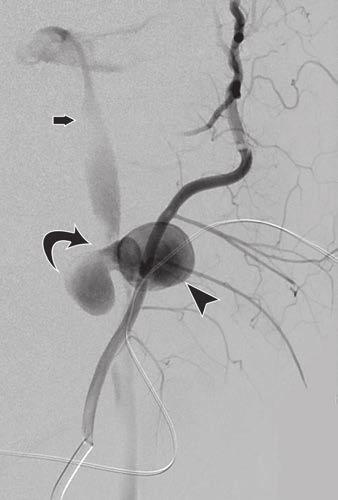 Nine of the 10 pseudoaneurysms involving the EC branches in our cohort were treated with endovascular embolization.