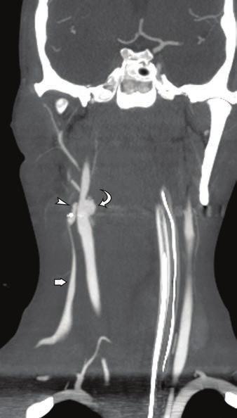 pseudoaneurysms were later embolized by endovascular means. Discussion The options available to identify arterial injuries in the neck after penetrating trauma include CT and DS.