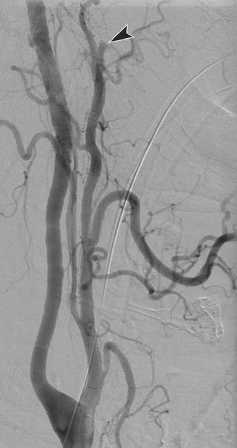 , Digital subtraction angiogram shows right internal maxillary artery occlusion (arrowhead).