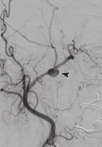pseudoaneurysm, which carries risk of rupture (Fig. 5).