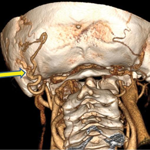 Ultrasound diagnostics of a spontaneous arteriovenous fistula of the head and neck Fig. 3.