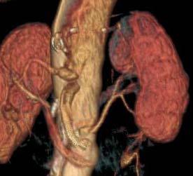 Left renal artery (LRA))