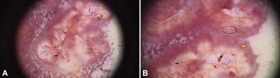 Dermoscopic features of squamous cell carcinoma of the