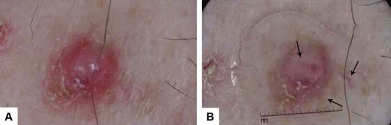 Clinical and dermoscopic features of combined cutaneous squamous cell carcinoma (SCC)/neuroendocrine [Merkel cell] carcinoma (MCC)