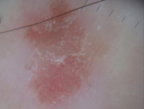 is: A.   Basal cell carcinoma 120 121 20