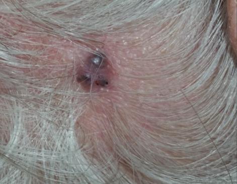 The most likely diagnosis is: A. Nodular melanoma B.