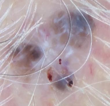 Pigmented basal cell carcinoma 132 133 22