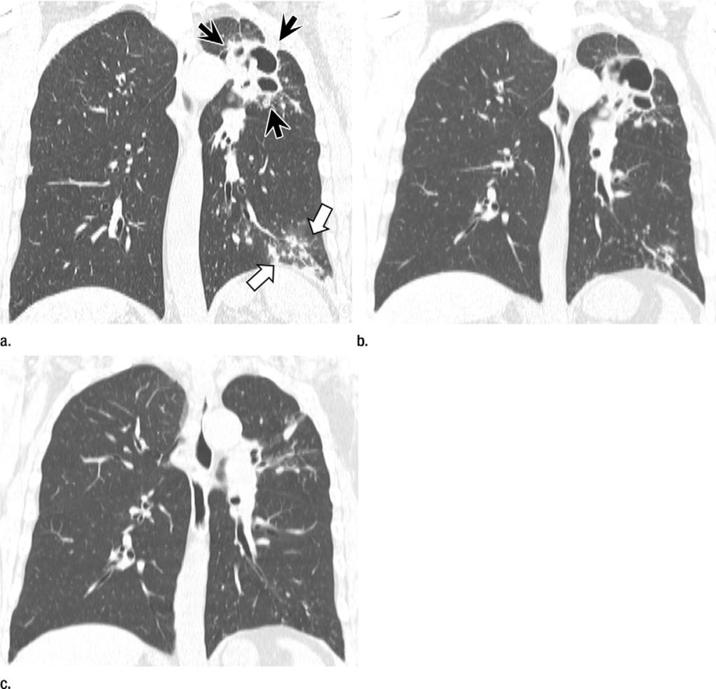 Figure 2 Figure 2: Serial CT scans of M massiliense disease of upper lobe cavitary form in 63-year-old man. (a) Coronal reformatted CT scan (2.
