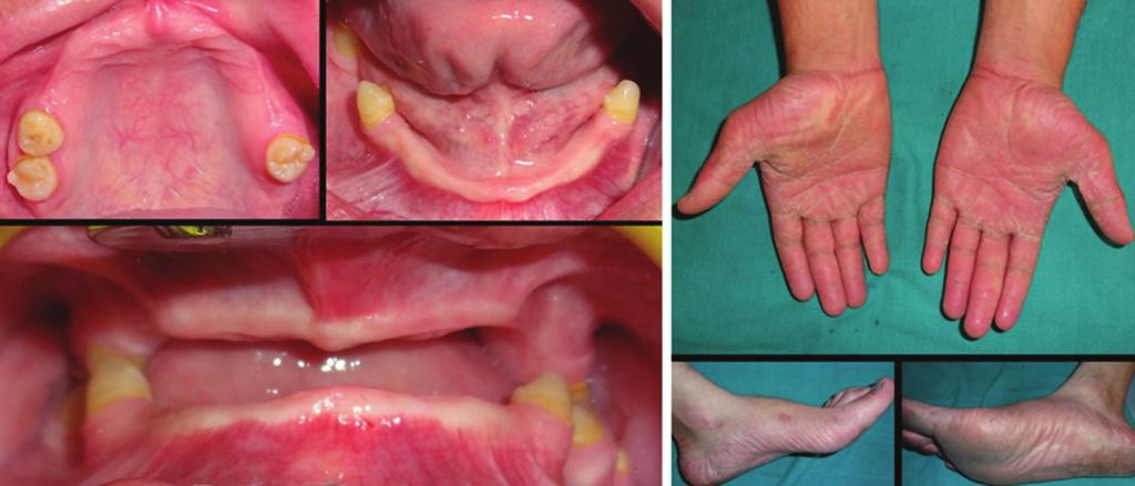 Figure 1: A photogrph of the ptient dignosed with Ppillon-Lefevre syndrome: () Introrl picture showing prtilly edentulous mxillry nd mndiulr rches with decresed interincisl distnce; () cutneous