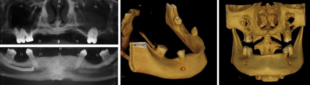 c d Figure 3 () Cone-em computed tomogrphy imge showing generlized one loss in mxill; () vrile mount of one loss is evident in nd round the teeth in mndile; (c) 3D reconstruction imge of mndile