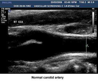 Carotid Ultrasound: INTIMA-