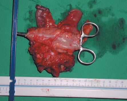 (3-B): Same postoperative specimen was opened showing tumor of the distal ileum. Fig.