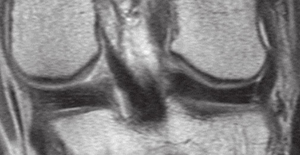 1 Sagittal proton density (PD)-weighted fast spin-echo (FSE) MR image of the left knee. 2a 2b 2c 2d 2e 2f Fig.