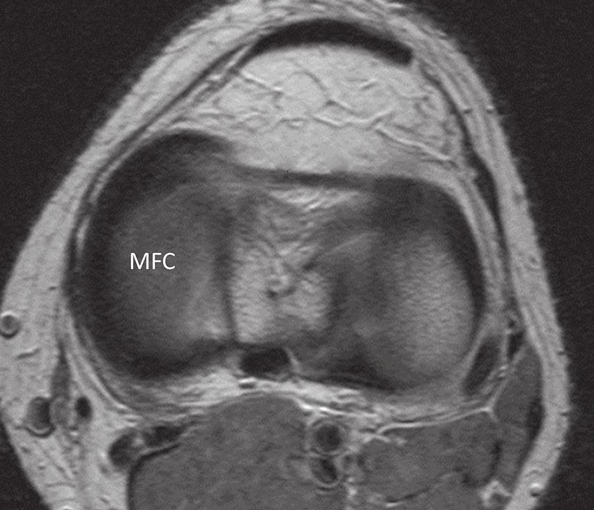 5a 5b 5c 5d Fig. 5 A separate patient with an oblique meniscomeniscal (MM) ligament without superimposed bucket-handle tear, and a high-grade tear of the anterior cruciate ligament.