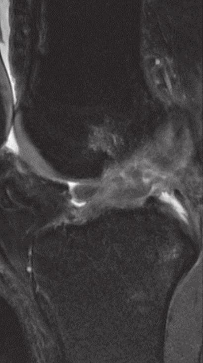 7 Coronal PD-weighted FSE MR image shows an anterior intermeniscal ligament (arrowheads).