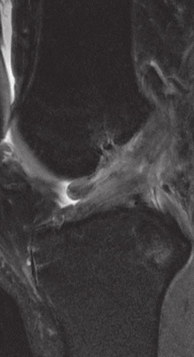 (2) To my best knowledge, there are no published reports on torn oblique MM ligaments and their imaging features.
