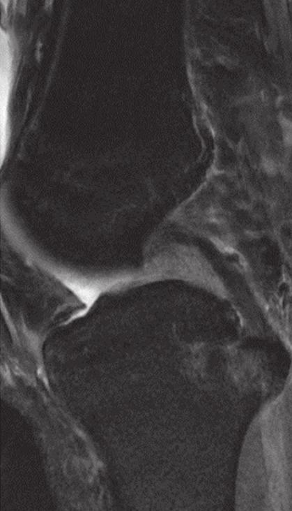 In a separate patient with an oblique MM ligament without superimposed bucket-handle tear (Fig. 5), the spurious double PCL sign would appear as shown in Fig. 5c.