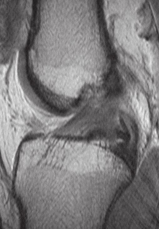 horns of the medial and lateral menisci. Increased signal intensity at the interface between the ligament and posterior horn of the lateral mimics a tear (9d).