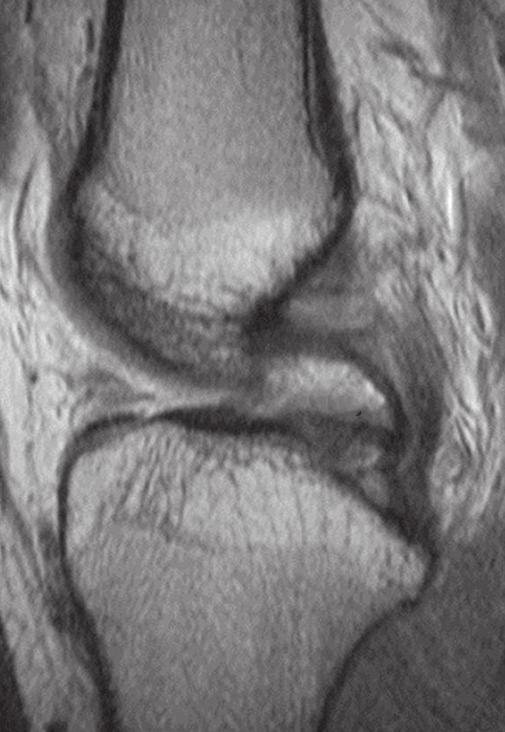 The anterior intermeniscal ligament is described in Gray s Anatomy as connecting the anterior convex margin of the lateral to the anterior end of the medial.