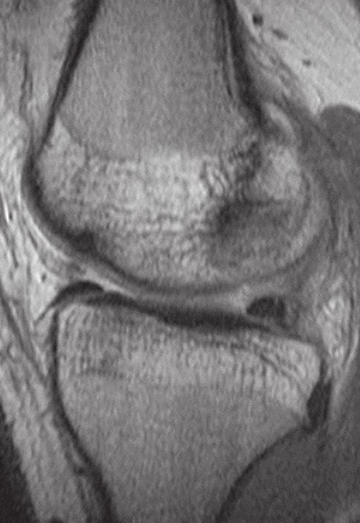 to the anterior margin of the medial and a lateral attachment to the joint capsule anterior to the lateral ; and Type III has medial and lateral capsular anterior attachments without direct