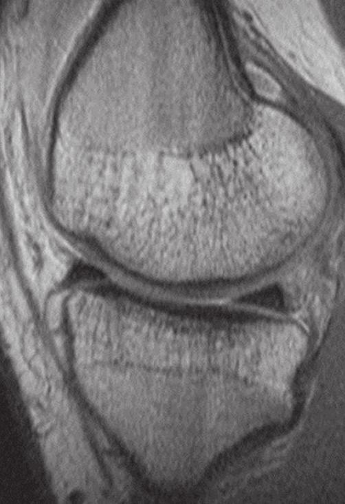 Regardless of insertion type, the region of confluence of the ligament with the anterior horn of the lateral and its central tendinous attachments can give the appearance of a highsignal cleft within